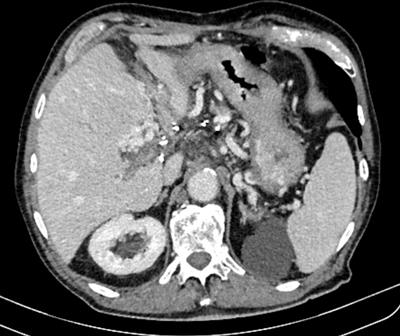 Long-term follow-up of complete remission in a patient with advanced hepatocellular carcinoma treated with sorafenib: a case report